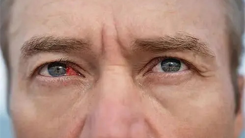 糖尿病眼病一般几年会失明 糖尿病眼病用什么药物治疗效果最好