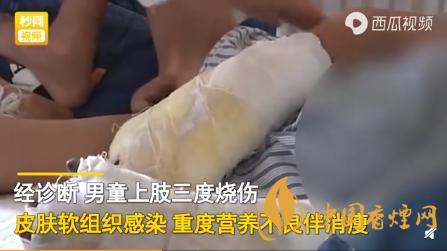 律师解读男孩被父亲烧伤 可能涉嫌虐待罪和故意伤害罪